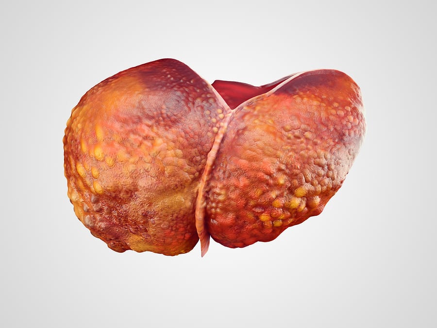 Long-term liver damage from drinking